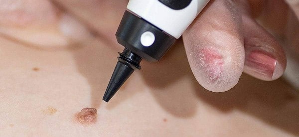 After Skin Tag Removal Orpington