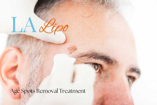 What Are the Most Effective Treatments for Age Spots Orpington?