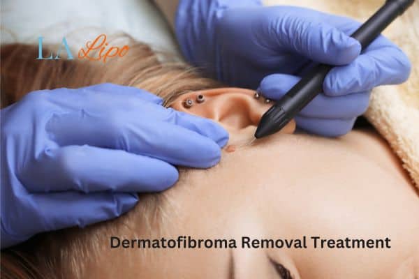 Dermatofibroma Removal Treatment Orpington