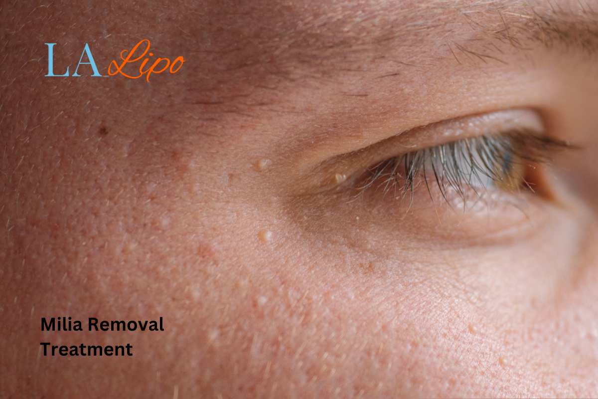 Cryopen Milia Removal: Is It the Easiest and Safest Option Orpington?