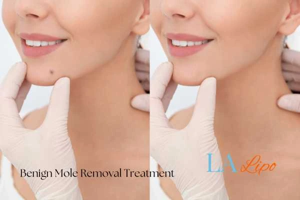 Before-and-after results following benign mole-removal treatment Orpington