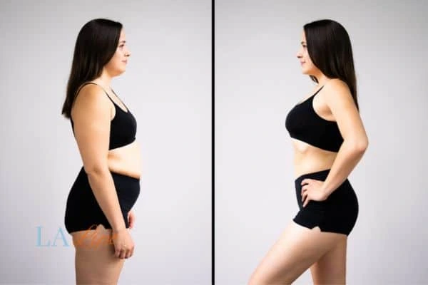 image of woman before and after results of LA-EMS Body Sculpting Orpington to help treat Diastasis recti