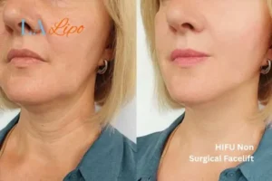 hi-fu for wrinkles Orpington before and after results