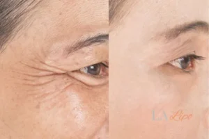 Before and after results of woman - HI-fu wrinkles reduction treatment Orpington