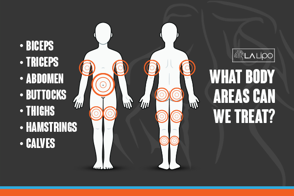 Graphic to show areas you can have LA-EMS Body Sculpting Orpington treatment.