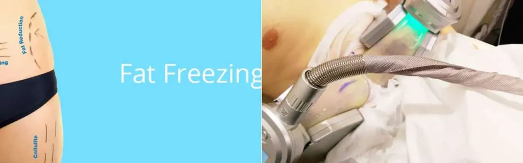 Fat freezing Orpington on multiple areas of the body
