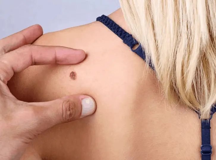 woman having mole removal Orpington consultation before treatment.