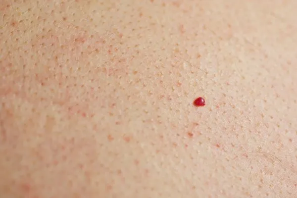 close up of a cherry angioma Orpington