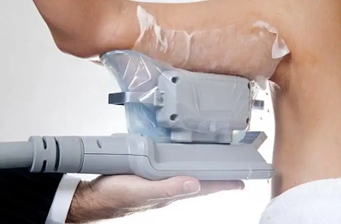Picture of fat freezing Orpington on the upper arms.