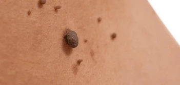 image of a skin tag Orpington