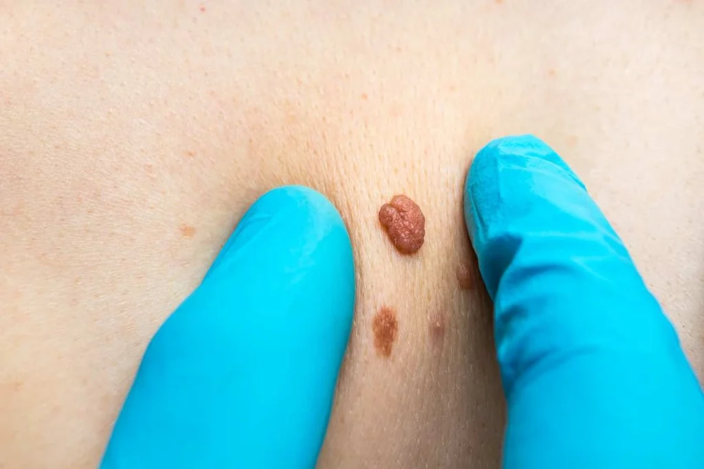 Consultant examining a skin tag Orpington