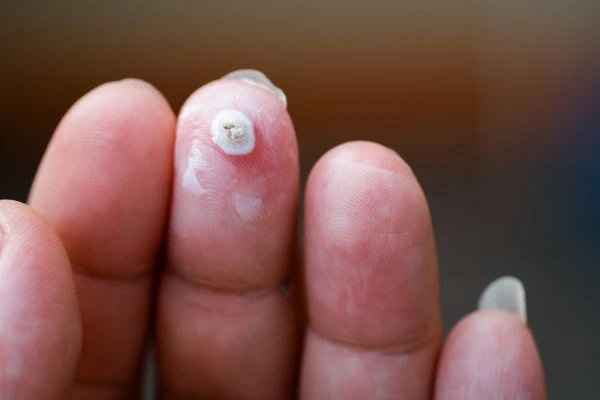 wart on person finger - cryotherapy to treat from LA LIPO Orpington