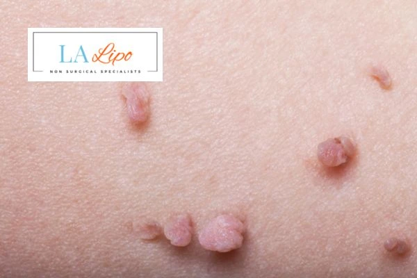 Does cryopen skin tag removal Orpington hurt? Find out now call our team today!