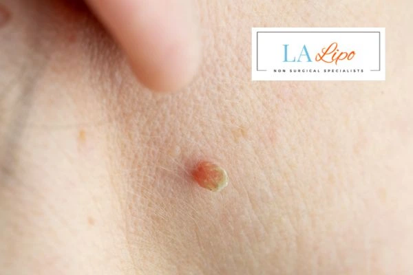 Book skin tag removal Orpington today speak to our team now!