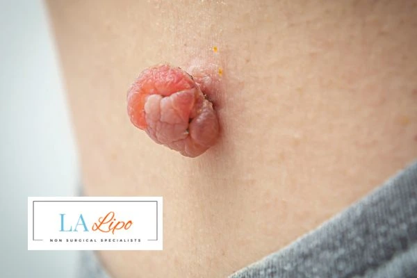 Interested in skin tag removal Orpington? Concerned about the pain? Find out more today!