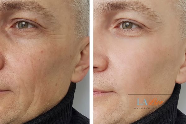 See the amazing results of Morpheus8 Treatment Orpington!