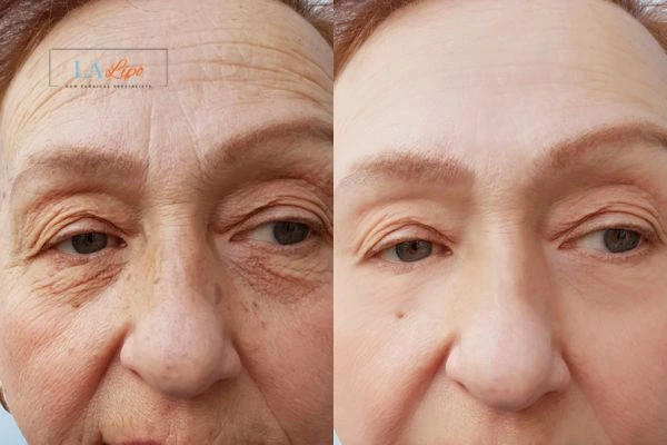 The powerful benefits of Morpheus8 Treatment Orpington - Call Our team today!