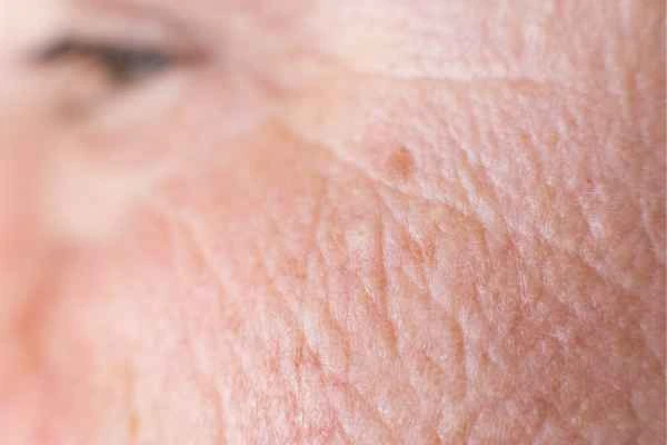 close up picture of a woman's face showing an age spot Orpington