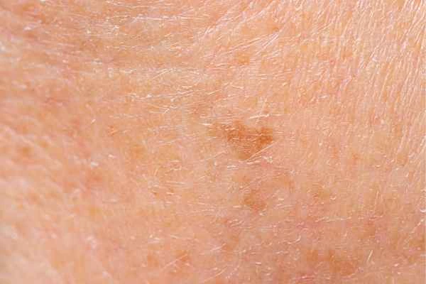 close up picture of age spots Orpington