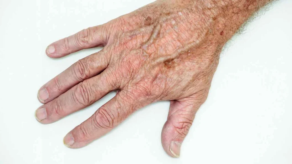 Male hand showing age spot Orpington