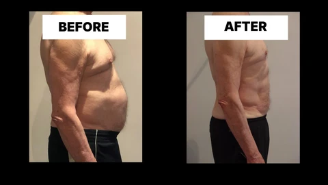 What Symptoms Can Diastasis Recti Cause in Men? Weak Core, Back Pain and Poor Posture Orpington